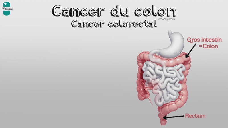 cancer colon