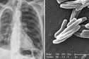 Suspicion d'un cas de tuberculose aux Abymes... Que faut-il savoir sur cette maladie ?