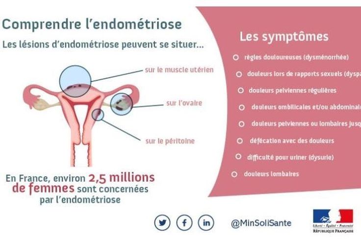 Endometriose Les Regles Sont Normales Pas Les Douleurs Guadeloupe La