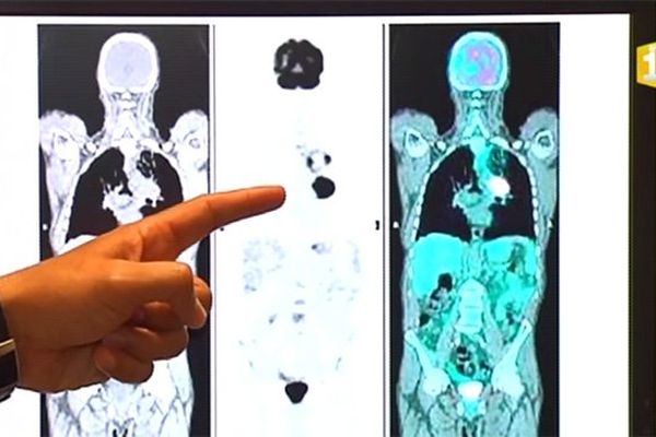 Image de cyclotron pour détecter de façon particulièrement fine certains cancers