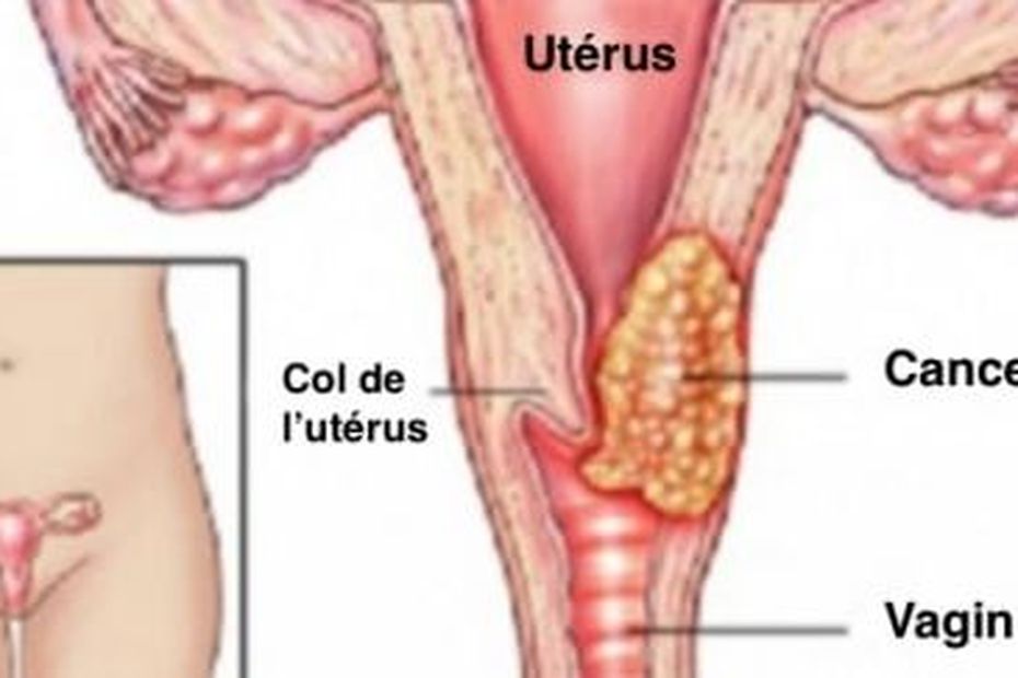 Une Journ E Pour Promouvoir Le D Pistage Du Cancer Du Col De Lut Rus