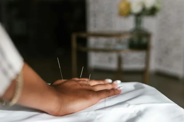 L'acupuncture, issue de la tradition médicale chinoise, fait partie des pratiques de soins dites non conventionnelles.