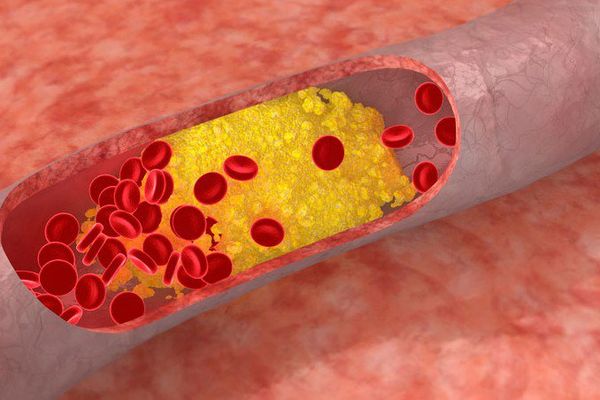 cholestérol