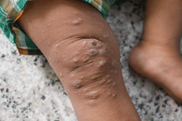 Mpox, variole du singe.