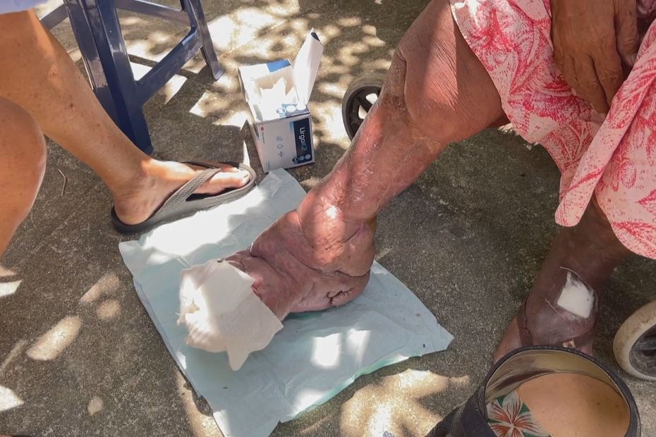 Filariasis Treatment Campaign in Polynesia: Updates and Progress