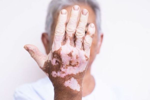 Le vitiligo, cette maladie chronique qui dépigmente la peau