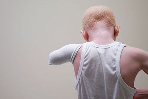 enfant albinos